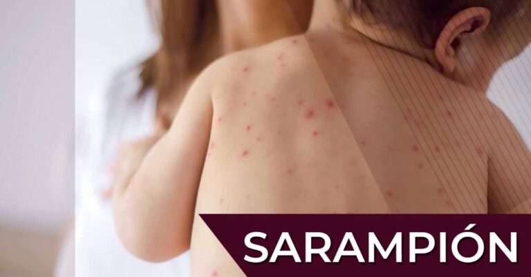 Sarampión, es más contagioso que la COVID-19